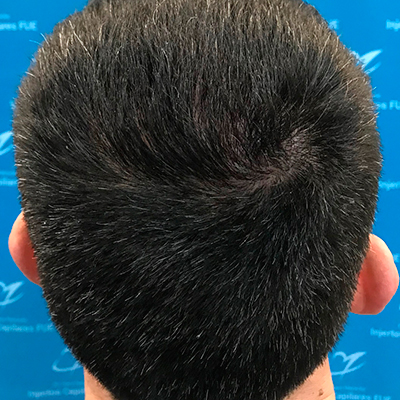 trasplante de cabello en Bilbao
